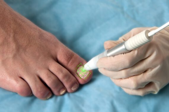 2012_05_nailfungus-FoxIII-5_2 (Medium)